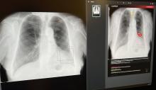 Umělá inteligence (AI) přináší revoluční změny do medicíny. V posledních letech se stává klíčovým faktorem v diagnostice a léčbě nemocí. Jedním z příkladů, jak AI mění zdravotnickou praxi, je systém Carebot, který používají na radiologickém oddělení v Nemocnici Tábor, a.s.